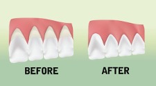 preventive gum therapy before and after 